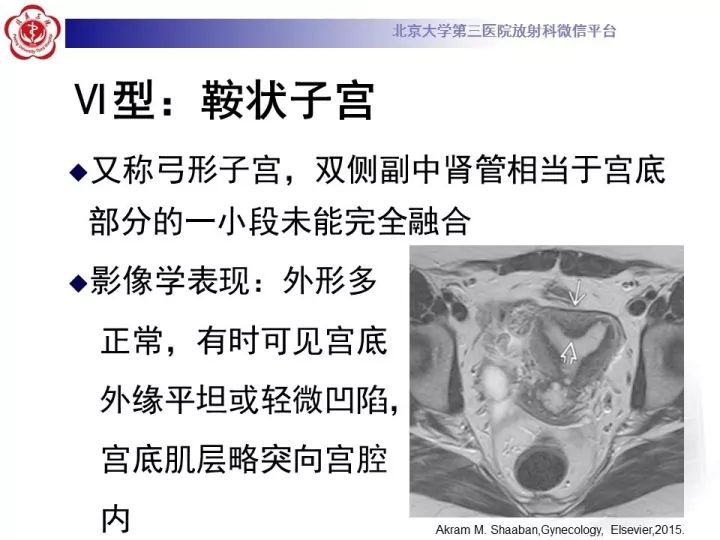 【病例】子宫发育畸形2例MR