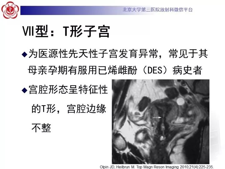 【病例】子宫发育畸形2例MR