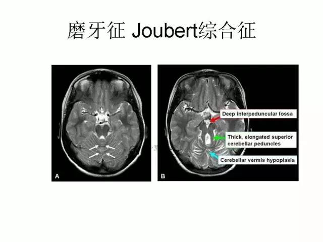 神经影像征象解析