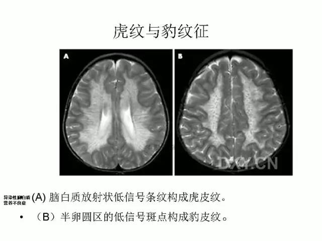 神经影像征象解析