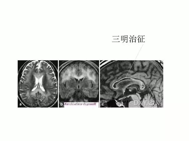 神经影像征象解析