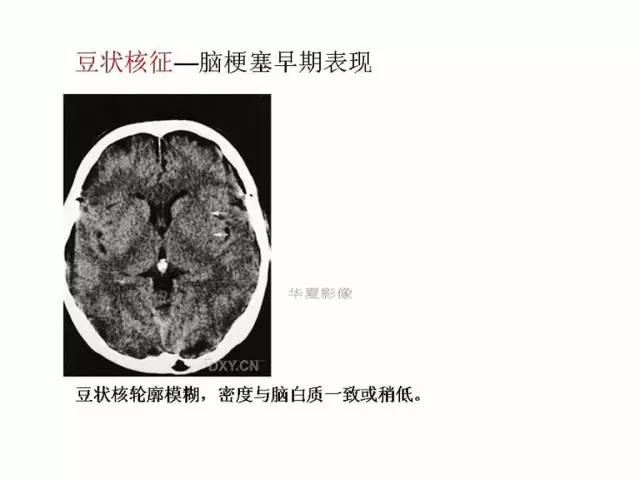 神经影像征象解析