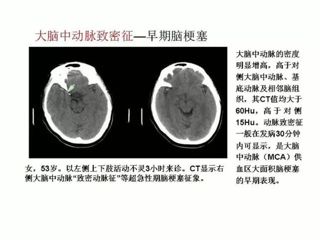 神经影像征象解析