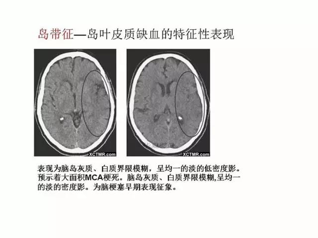 神经影像征象解析