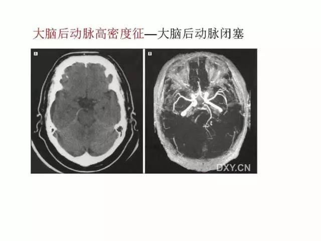 神经影像征象解析