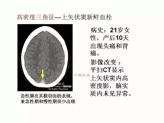 神经影像征象解析
