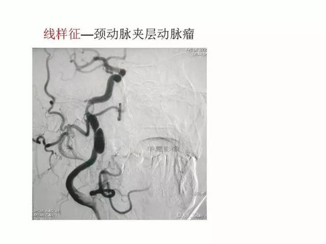 神经影像征象解析
