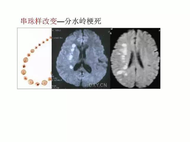 神经影像征象解析