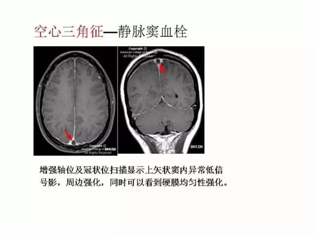 神经影像征象解析
