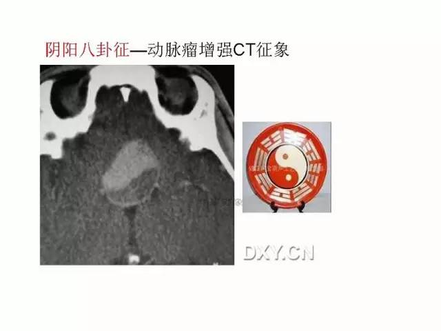 神经影像征象解析