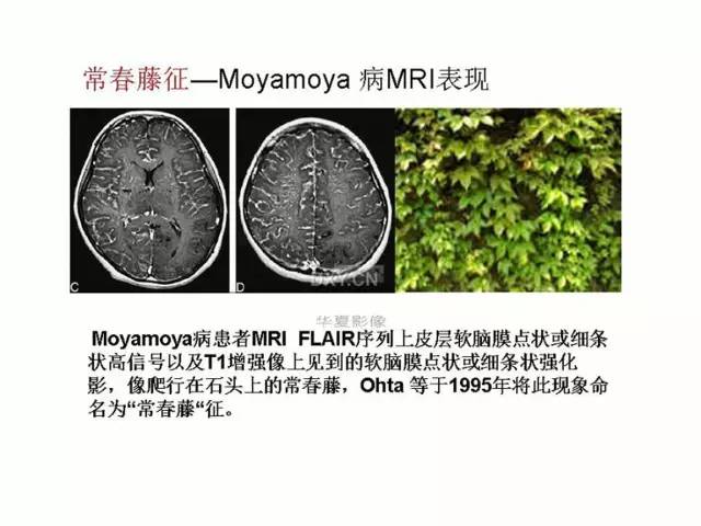 神经影像征象解析