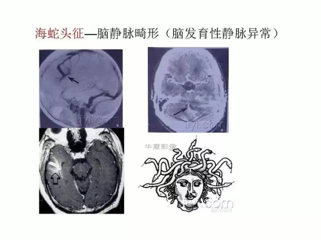 神经影像征象解析