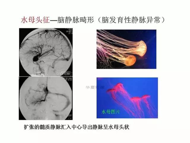神经影像征象解析