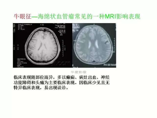 神经影像征象解析