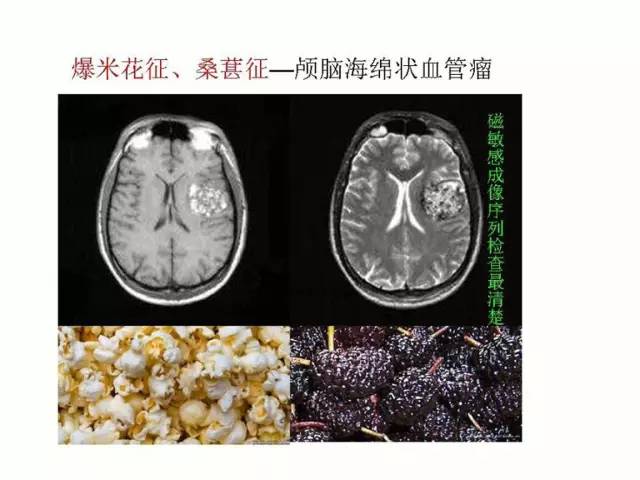 神经影像征象解析