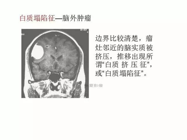 神经影像征象解析