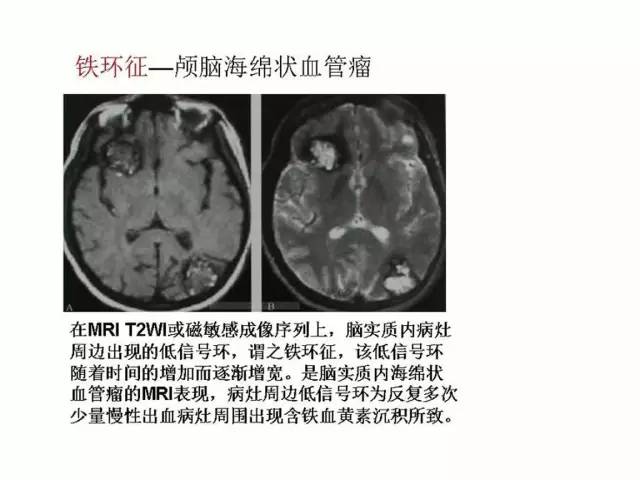 神经影像征象解析
