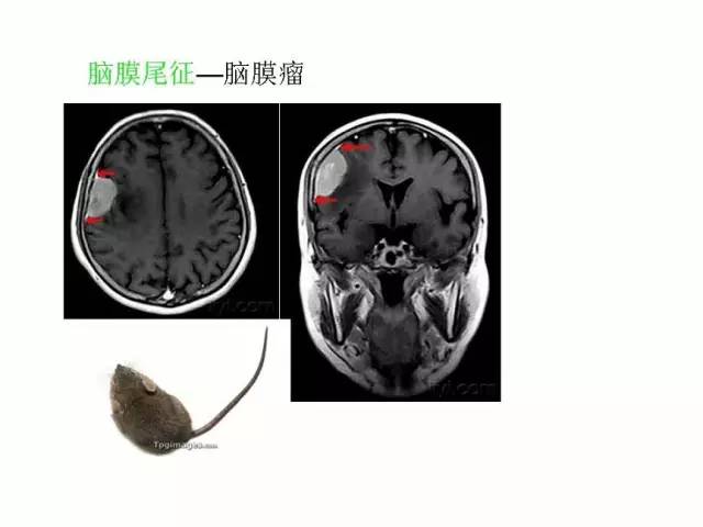 神经影像征象解析