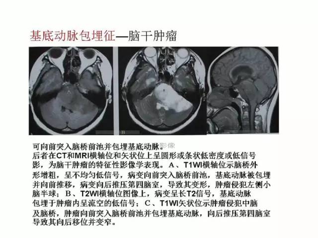 神经影像征象解析