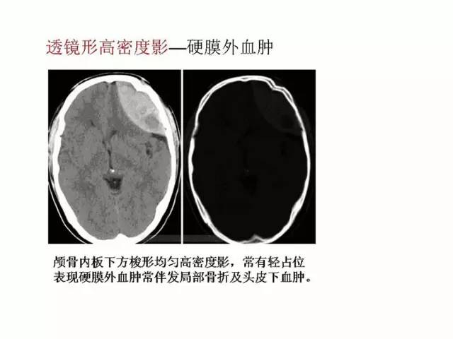神经影像征象解析