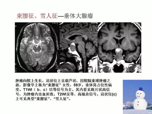 神经影像征象解析