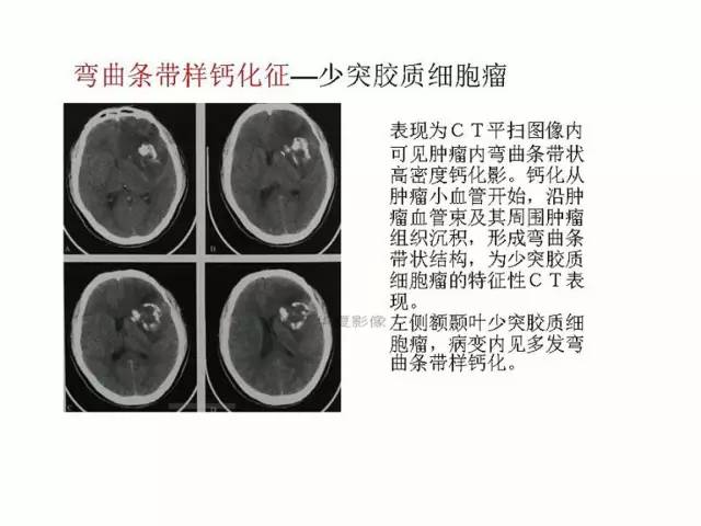 神经影像征象解析