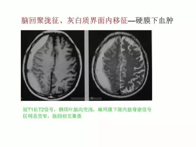 神经影像征象解析
