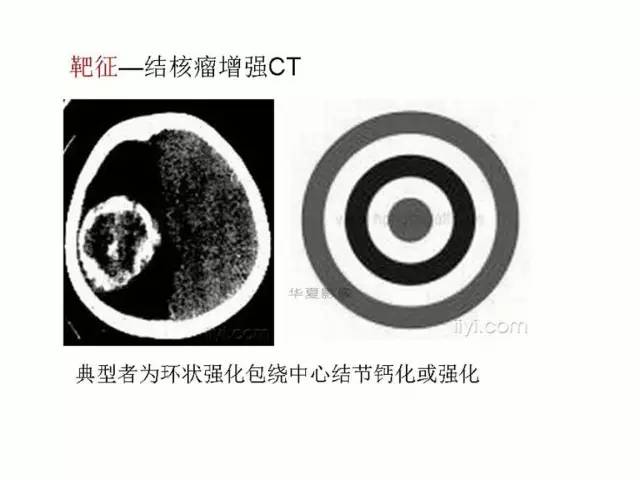 神经影像征象解析