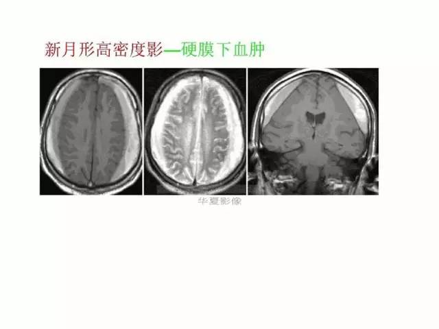 神经影像征象解析