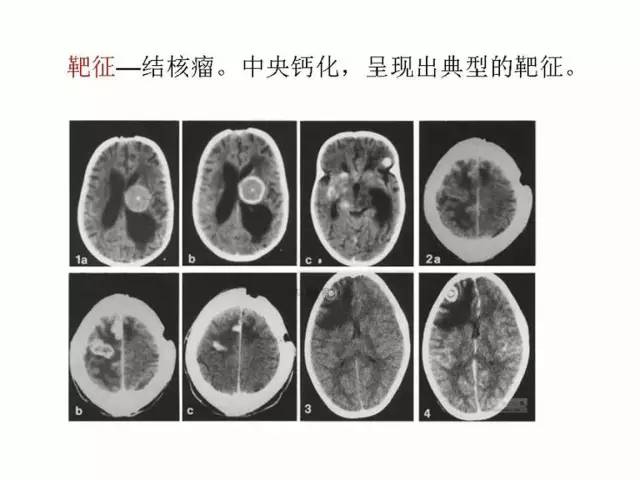 神经影像征象解析