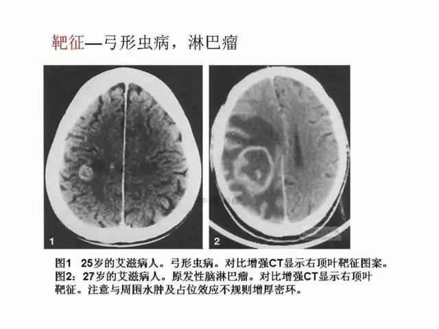 神经影像征象解析