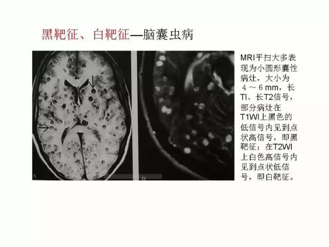 神经影像征象解析