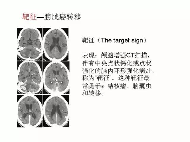 神经影像征象解析