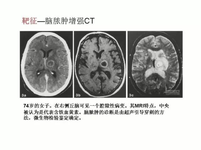 神经影像征象解析