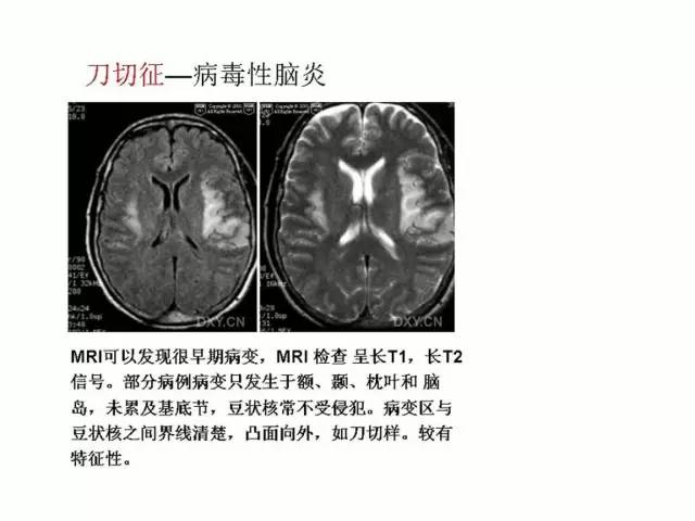 神经影像征象解析