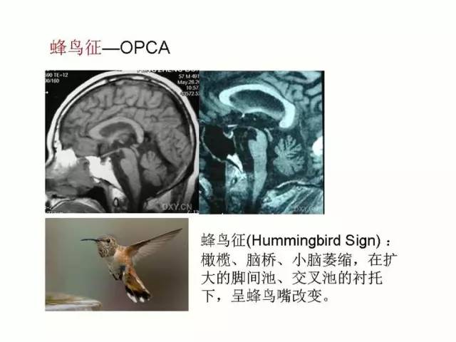 神经影像征象解析