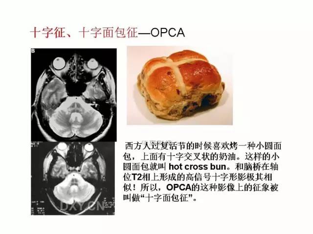 神经影像征象解析