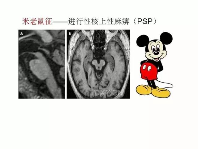 神经影像征象解析