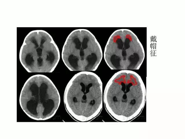 神经影像征象解析