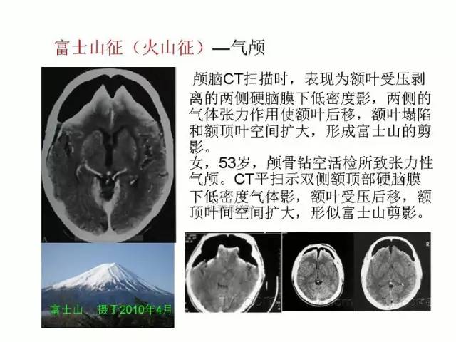 神经影像征象解析