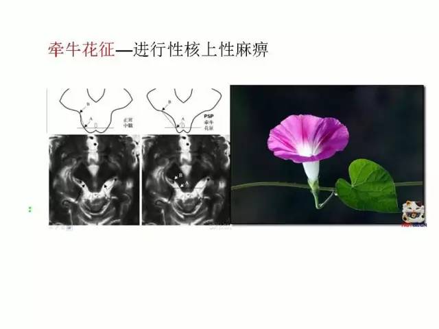 神经影像征象解析