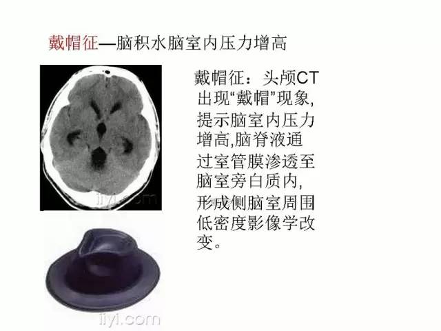 神经影像征象解析