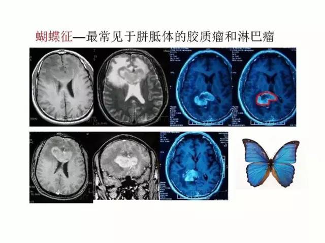 神经影像征象解析