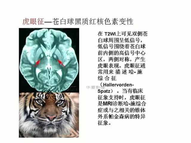 神经影像征象解析