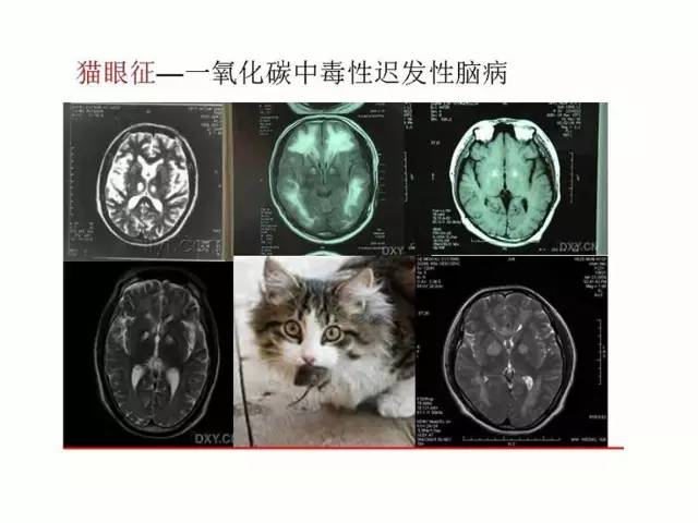 神经影像征象解析