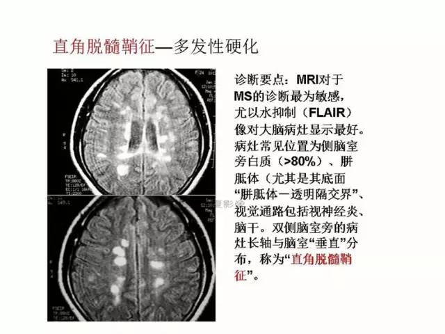 神经影像征象解析