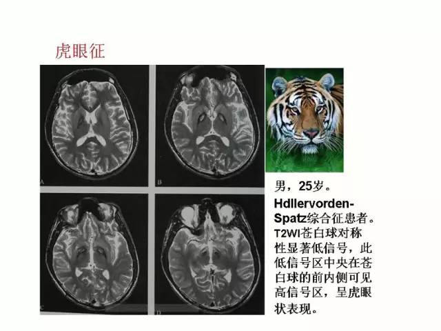 神经影像征象解析