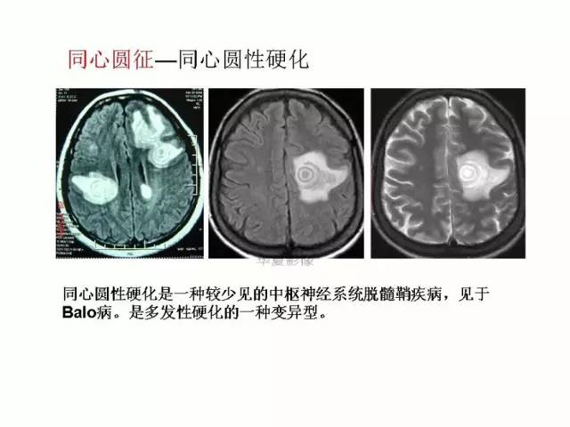 神经影像征象解析