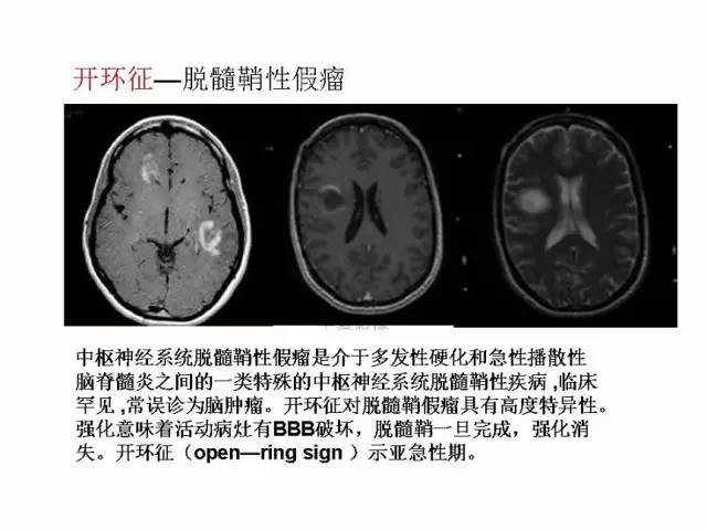 神经影像征象解析