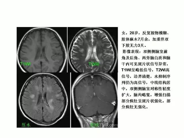 神经影像征象解析